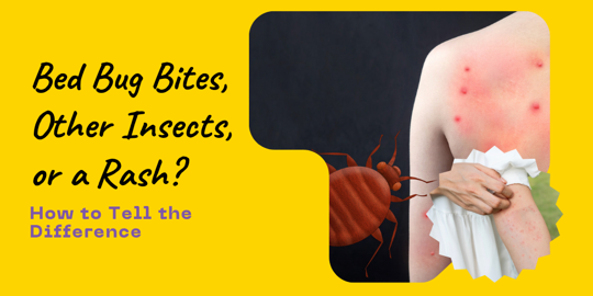 Bed bug bites